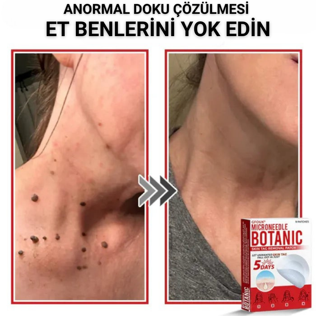 Ryles Mikro İğneli Ben Düşürücü Bant – 5 Günde İz Bırakmadan Düşürür