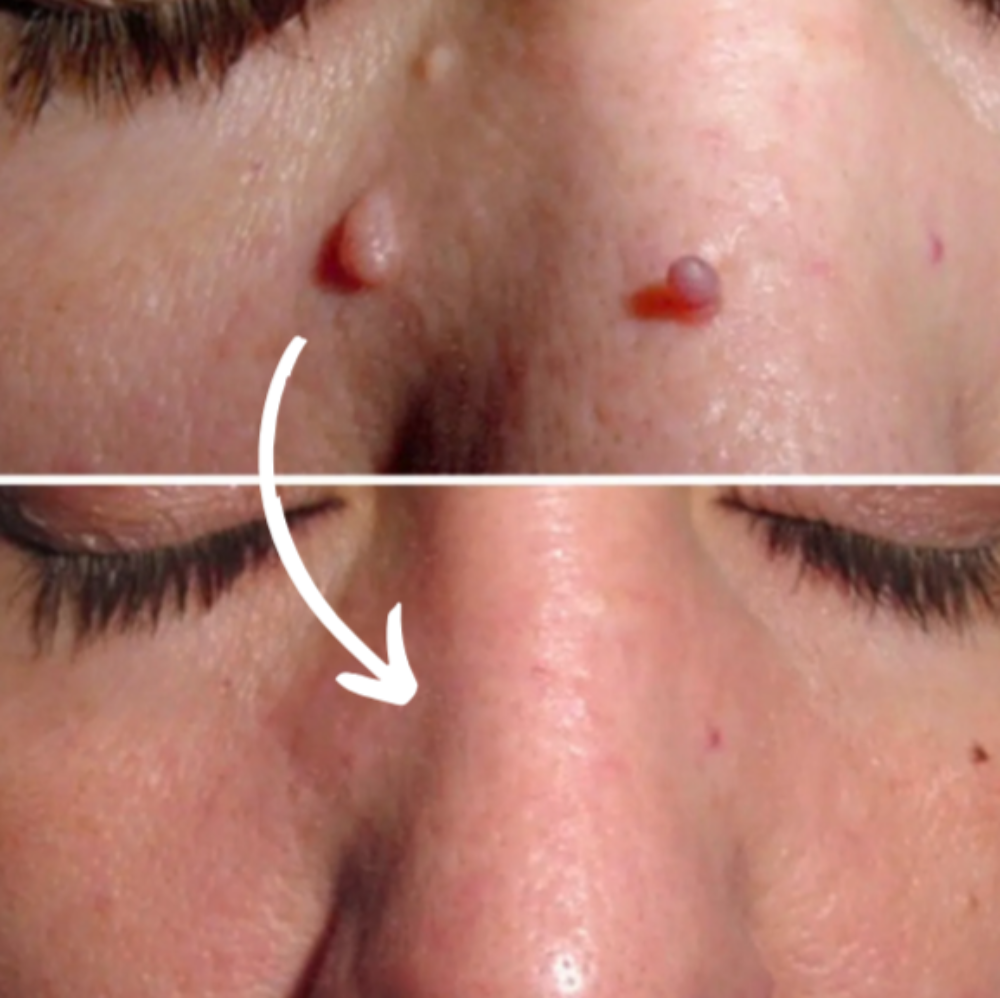 Ryles Mikro İğneli Ben Düşürücü Bant – 5 Günde İz Bırakmadan Düşürür