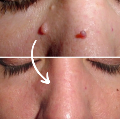 Ryles Mikro İğneli Ben Düşürücü Bant – 5 Günde İz Bırakmadan Düşürür