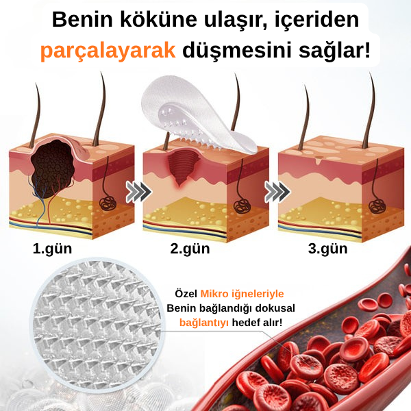 Ryles Mikro İğneli Ben Düşürücü Bant – 5 Günde İz Bırakmadan Düşürür