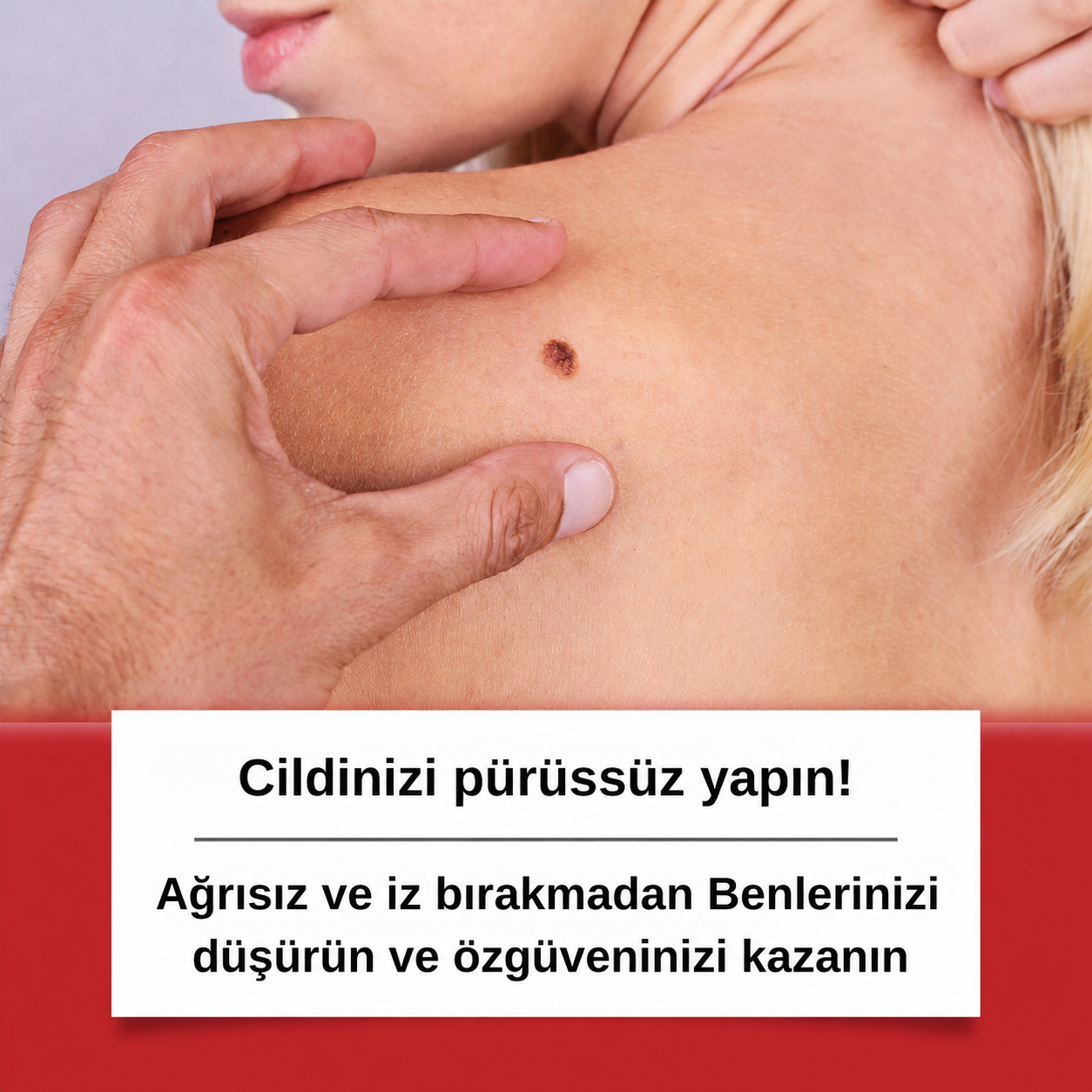 Ryles Mikro İğneli Ben Bandı 5 Günde Acısız Son!