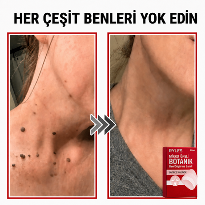 Ryles Mikro İğneli Ben Bandı 5 Günde Acısız Son!