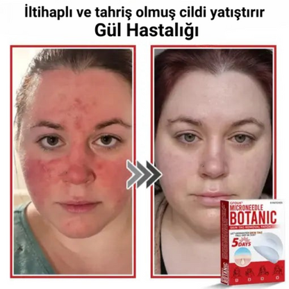 Ryles Mikro İğneli Ben Düşürücü Bant – 5 Günde İz Bırakmadan Düşürür