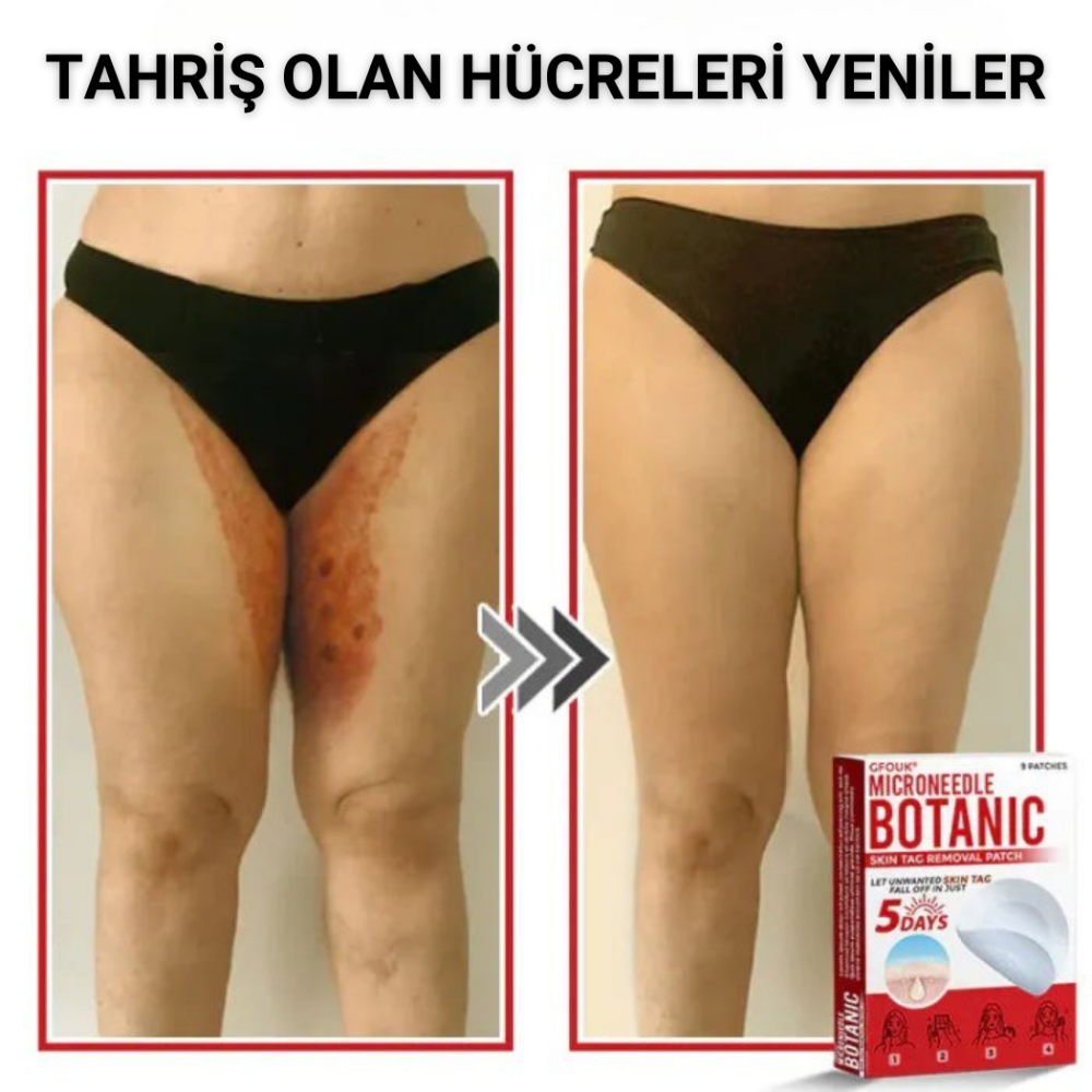 Ryles Mikro İğneli Ben Düşürücü Bant – 5 Günde İz Bırakmadan Düşürür